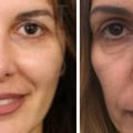 What is the most effective non surgical facelift?