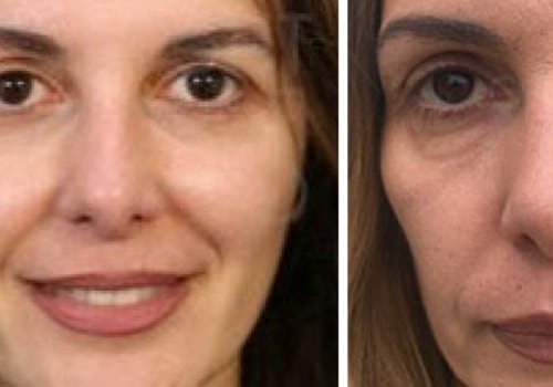 What is the most effective non surgical facelift?